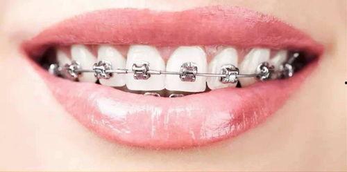 成人正畸步骤视频教学